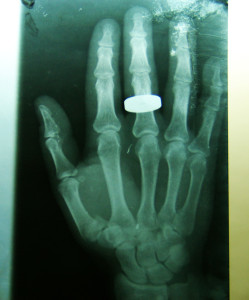 Röntgenbild vom Daumenbruch